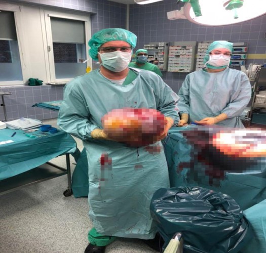 İkiz Bebek Taşıdığını Sandılar, Karnından 10 Kiloluk Tümör Çıktı!
