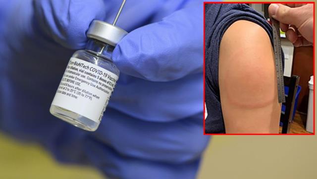 Moderna’nın Koronavirüs Aşısını Yaptıran 14 Kişinin Kolunda 1 Hafta İçinde Ağrılı Kırmızı Şişlikler Oluştu