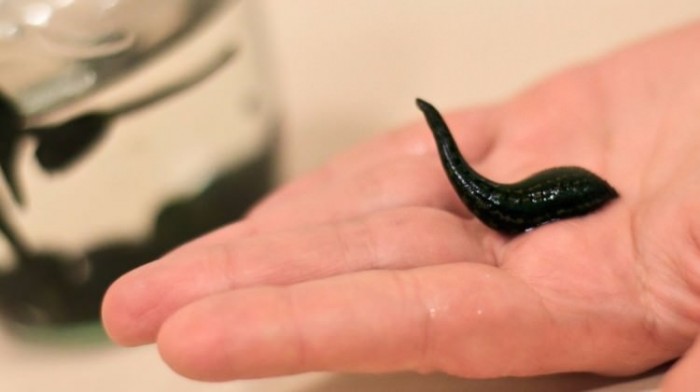 Sülük Tedavisinde Hepatit Riski Var